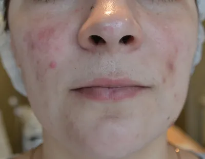 Anti-acne Пенка-мусс для умывания для проблемной кожи, 150 мл. Очищение,  нормализация работы сальных желёз, уменьшение количества чёрных точек.  арт.4239 купить в интернет-магазине Dr.Kozhevatkin | Бесплатная доставка и  cash-back за каждую покупку