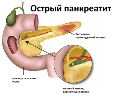 Капельницы для поджелудочной - Clean Clinic