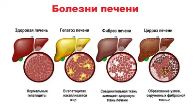 Поджелудочная железа, заболевания.