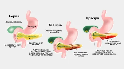 Лечение заболеваний поджелудочной железы - Услуги