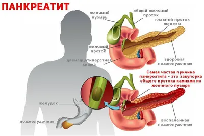 Желчегонные средства Pro.Med.CS Praha Урсосан | отзывы