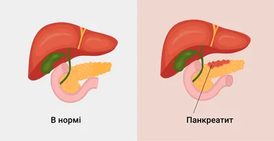 Цвет кала при панкреатите - Медправда