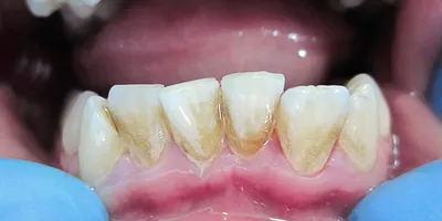 Зубной камень: причины, виды, лечение