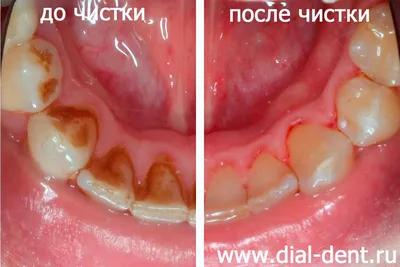 Удаление зубного камня в Москве — цены, рекомендации