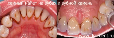 Зубной камень: как убрать, симптомы и причины появления, удаление в  домашних условиях, лечение в стоматологии