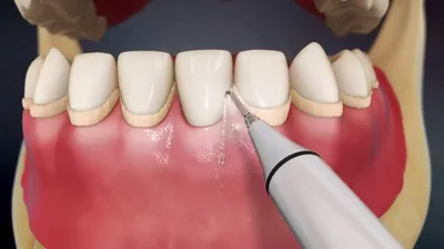 Зубной камень: что это, виды и способы удаления камня на зубах -  Стоматология Доктор Келлер в Батайске