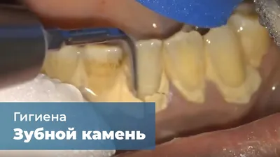 Что такое зубной камень? - DentaGuard