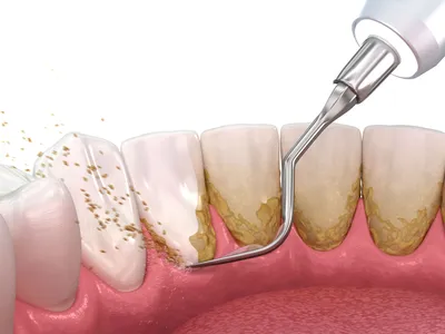 Удаление зубного камня - DENTALMAGAZINE.RU