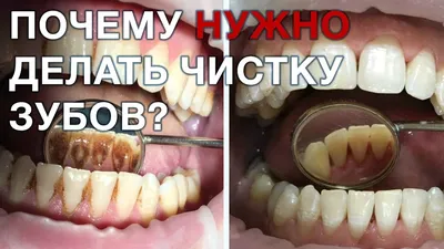 Чистка зубов в Одессе - удаление зубного камня ультразвуком | «Profident  Junior»