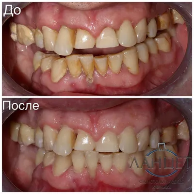 Зубной камень: удаление в Минске, цены на ультразвуковую чистку