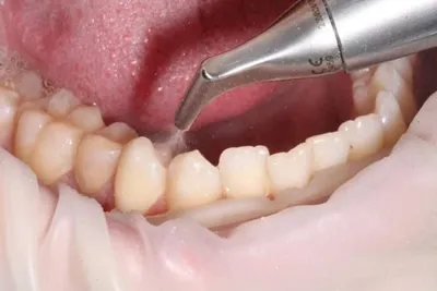 Чистка зубов от камня в стоматологической клинике в Москве \"Ланцет\" -  стоимость лечения