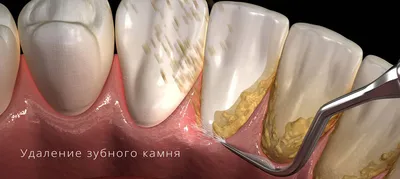Зубной камень — причины, симптомы, лечение и профилактика | Стоматология 24