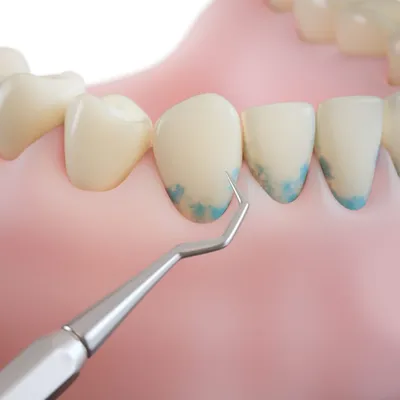 Зубной камень - Элис - Стоматологическая клиника