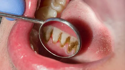 Зубной камень и ортодонтический ретейнер | Стоматолог СПб | Ившина Юлия |  Дзен