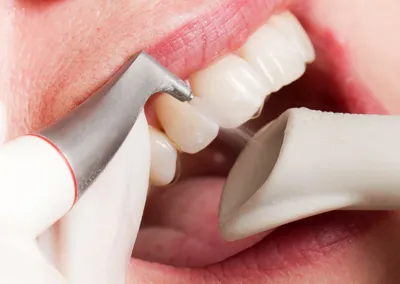 Рейтинг лучших зубных паст для удаления налета и зубного камня