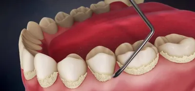 Удаление зубного камня в Днепре | ДантистЪ