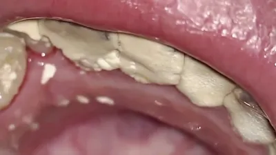 Целесообразность чистки зубов перед лечением - полезная информация от  врачей стоматологии доктора Фролова