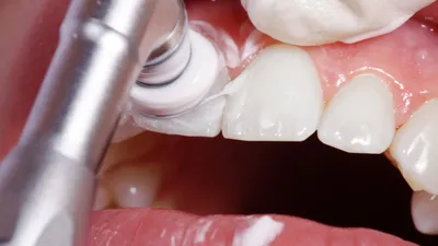 Приватна стоматологія - Как можно понять, что у вас есть зубной камень?  Основной симптом - это отложения между зубами и вокруг шейки зубов, и  легкое покраснение десен. Сначала зубной камень рыхлый, и