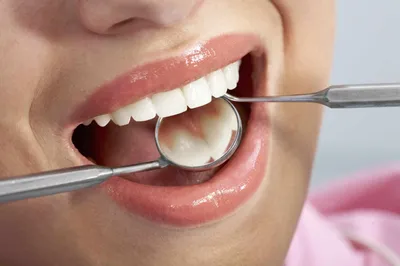 Удаление зубного камня, запущенный случай. Гигиена полости рта - YouTube