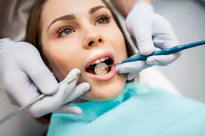 Удаление зубного камня | Цены на удаление зубного камня ультразвуком,  лазером в «СМ-Стоматология» во Владимире