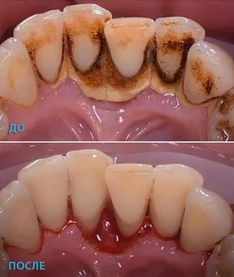 Что такое зубной камень? Виды лечения зубного камня, профилактика