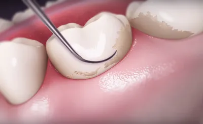 Чем опасен зубной камень и как с ним бороться? — Классика — центр  стоматологии