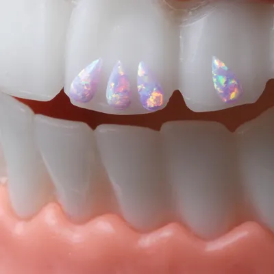 Кариозная полость на вестибулярной поверхности зуба