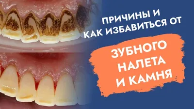 Запущений зубний камінь у собаки. Ультразвукове чищення зубів