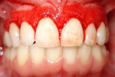Как удаляют зубные отложения, зубной камень в стоматологии?