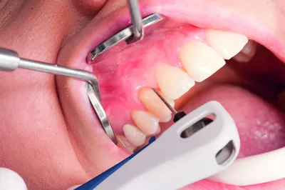 Что такое зубной камень? Правда ли, что он может стать причиной потери  зубов? Как предотвратить его появление? Рассказывает наш… | Instagram