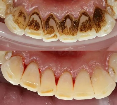 Камни на зубах: причины и методы удаления