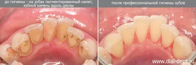 Чистка зубного камня - причины, вред и лечение