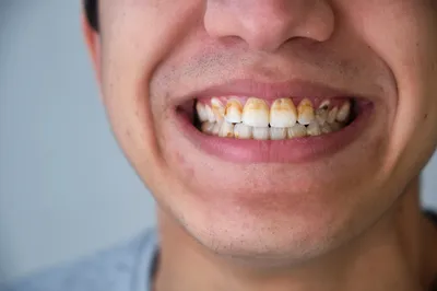Что такое зубной камень и причины его образования.