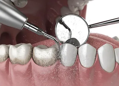 Как избавиться от зубного камня: 8 лучших способов с отзывами, можно ли  избавиться в домашних условиях, советы врачей