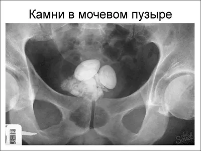 Литотрипсия камней почек в СПб - сделать дробление камней в почках  ультразвуком, цены