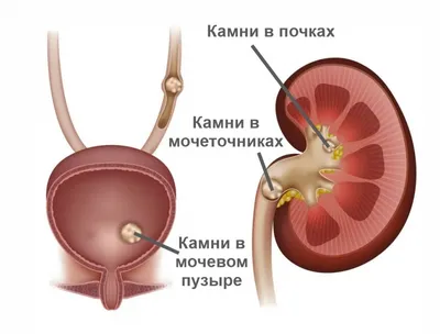 Как избавиться от камней и песка в почках. Личный опыт Максима Лапина