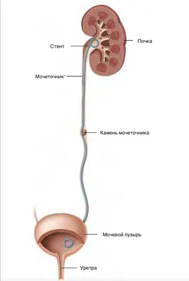 Камни в почках, все что нужно знать - UROSVIT