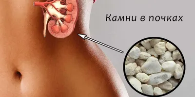 Урология » Одиночные камни нижней чашечки почки: как лечить?