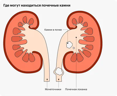 Уролог назвал размер камней в кочках, которые сами не выйдут - KP.RU