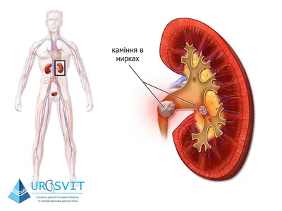 Уролитиаз (мочекаменная болезнь)