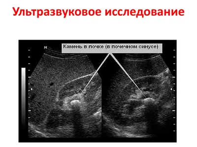 Камни в почках - причины появления, при каких заболеваниях возникает,  диагностика и способы лечения