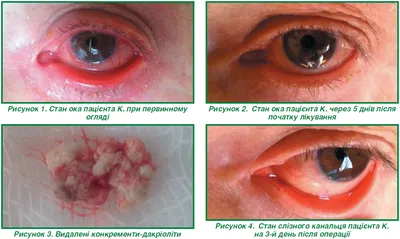 Как быстро снять отек при конъюнктивите? - энциклопедия Ochkov.net