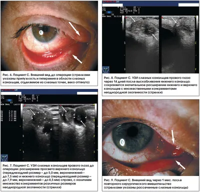 Офтальмология. Каналикулит - презентация онлайн