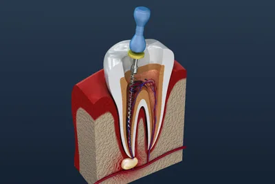 Как лечат каналы зуба? - статья от стоматологической клиники «Ионика»