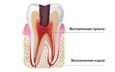 Лечение корневых каналов зуба в Москве - цена и отзывы