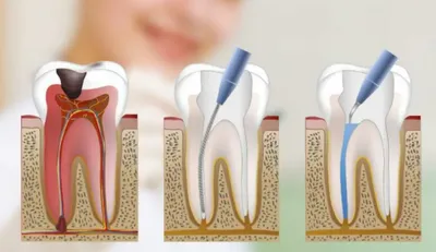 Лечение каналов бокового зуба | Стоматологическая клиника Долгих