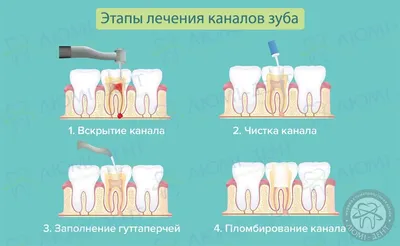 Лечение каналов зуба в Москве | Цена на лечение каналов зуба в стоматологии  Deva-Dent