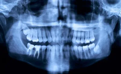 Лечение корневых каналов зуба