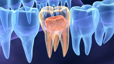 Чистка каналов зуба: почему и сколько болит зуб после пломбирования каналов