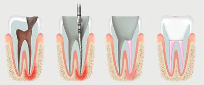 Почему после удаления нерва важно хорошо запломбировать каналы зуба? ::  NORD DENTAL — семейная стоматология. Две клиники на севере Петербурга